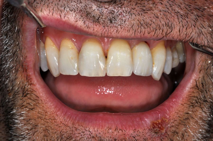 teeth in a day - after